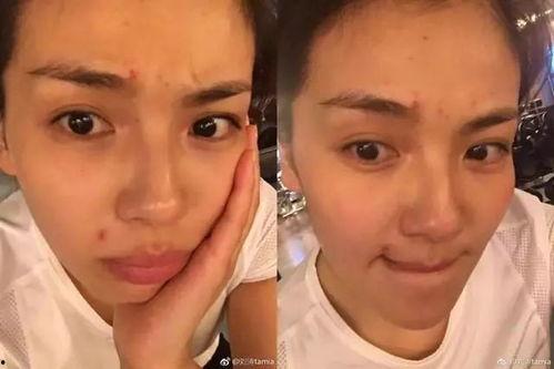 去痘痘视频在线观看国产,揭秘去痘痘视频，告别痘肌困扰